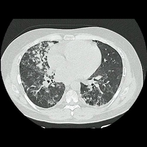 Paciente de 35 años con neutropenia febril
