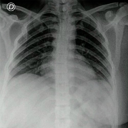 Anexo 1. Radiografía de tórax frente