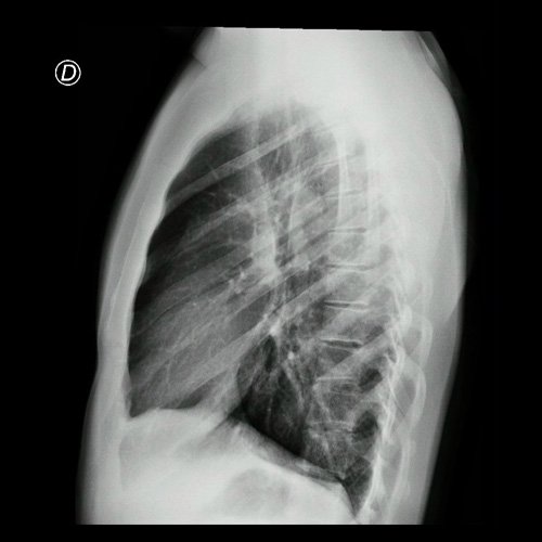 Radiografía de tórax frente y perfil  Día 3 