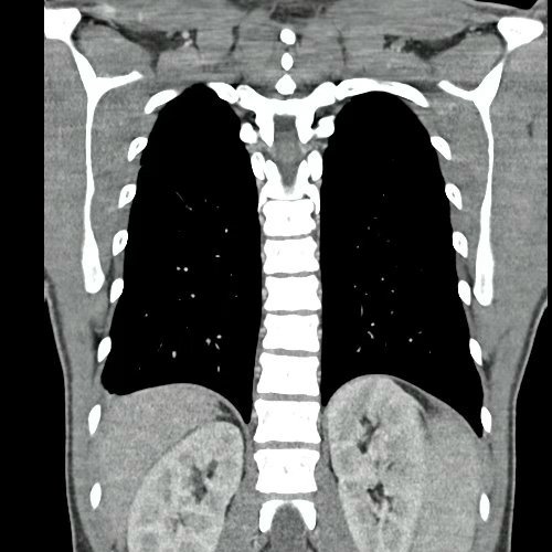 Neutropenia en paciente varón con esferocitosis hereditaria