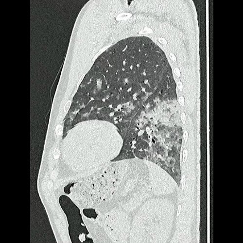 Tomografía de tórax sin contraste endovenosos (Ventana pulmonar- corte sagital)