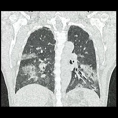 Tomografia de torax sin contraste endovenosos (Ventana pulmonar- Corte coronal)