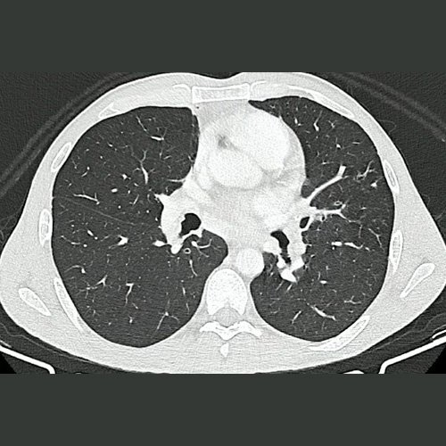 Tomografía de tórax (Ventana pulmonar-corte axial) DÍA 1