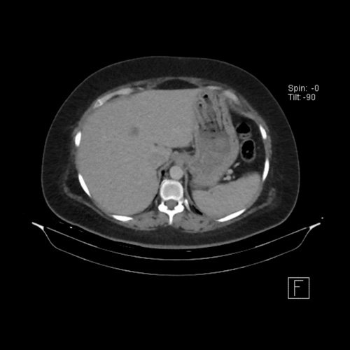 TC de abdomen y pelvis con contraste endovenoso (12/02/2026) Corte axial: hígado de forma, tamaño y situación habituales, con superficie lisa y bordes agudos.  Imagen hipovascular aislada de 15 mm en segmento V de aspecto inespecífico. 