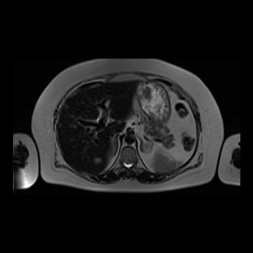 RMN de abdomen con contraste endovenoso (14/02/26)  Corte coronal (T2): adenoma suprarrenal izquierdo; lesión hepática redondeada hiperintensa redondeada en segmento VII.