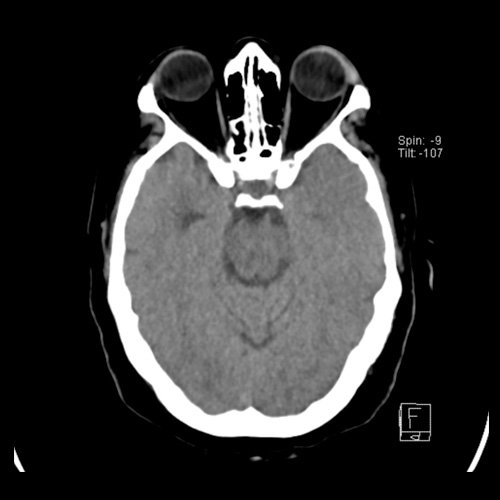 Tomografia de craneo con contraste endovenoso (10/02/2026) Corte axial: sin alteraciones a nivel selar.