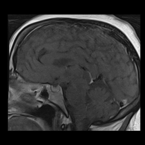 RMN de cráneo con contraste endovenoso (21/02/26) Corte sagital en secuencia T1: sin alteraciones en región selar.