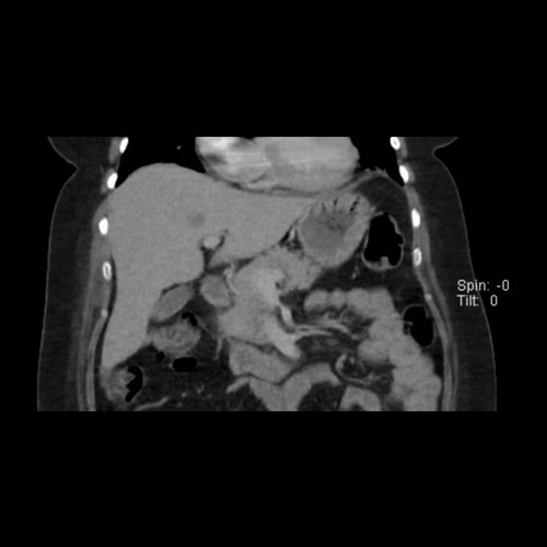TC de abdomen y pelvis con contraste endovenoso (12/02/2026) Corte coronal: hígado de forma, tamaño y situación habituales, con superficie lisa y bordes agudos.  Imagen hipovascular aislada de 15 mm en segmento V de aspecto inespecífico. 