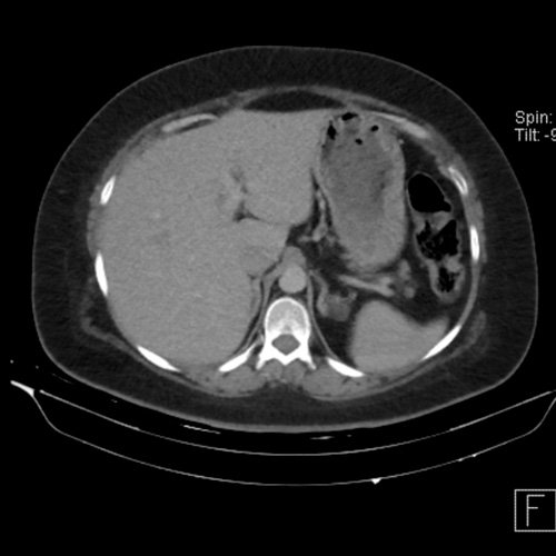 TC de abdomen y pelvis con contraste endovenoso (12/02/2026) Corte axial: adenoma adrenal izquierdo de 16 mm.