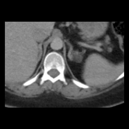 TC de abdomen y pelvis con contraste endovenoso (12/02/2026) Corte axial: adenoma adrenal izquierdo de 16 mm.
