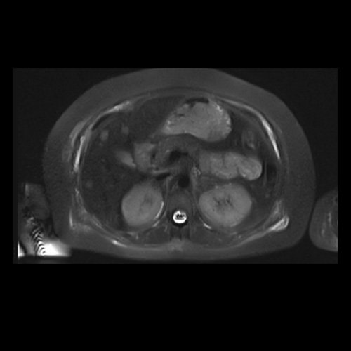 RMN de abdomen con contraste endovenoso (14/02/26)  Corte axial (T2): múltiples lesiones sólidas de distribución difusa, levemente hiperintensas. 