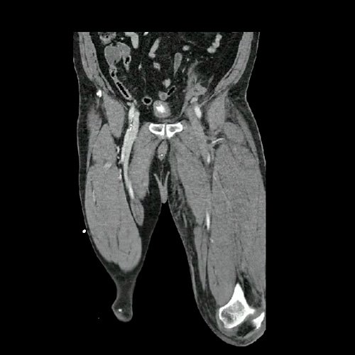 Angio TAC de miembros inferiores (Día 0)