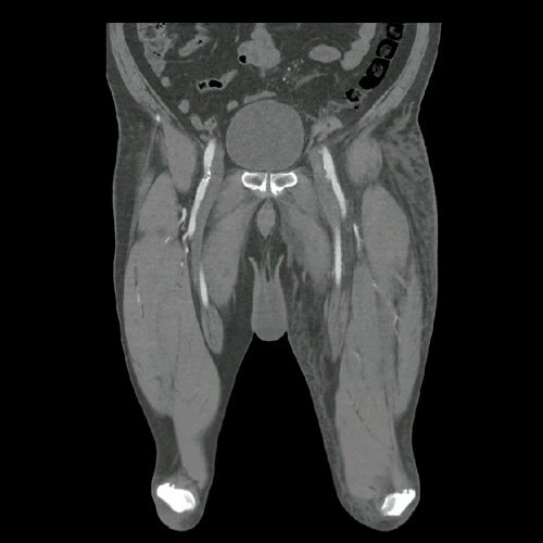 Angio TAC de miembros inferiores (Día 2)
