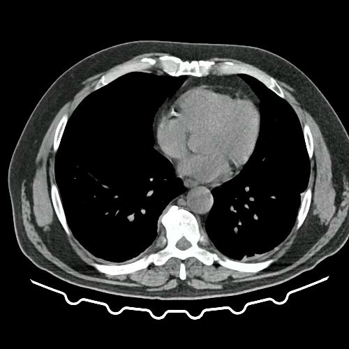 TAC de tórax, abdomen y pelvis con contraste EV (Día 10) Corte axial