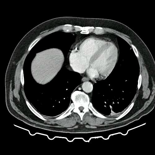TAC de tórax, abdomen y pelvis con contraste EV (Día 10) Corte axial