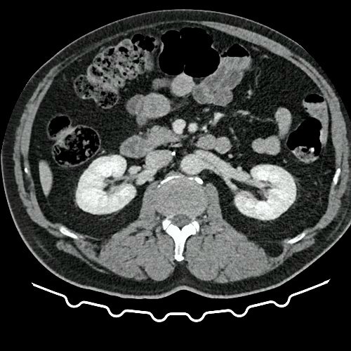 TAC de tórax, abdomen y pelvis con contraste EV (Día 10) Corte axial