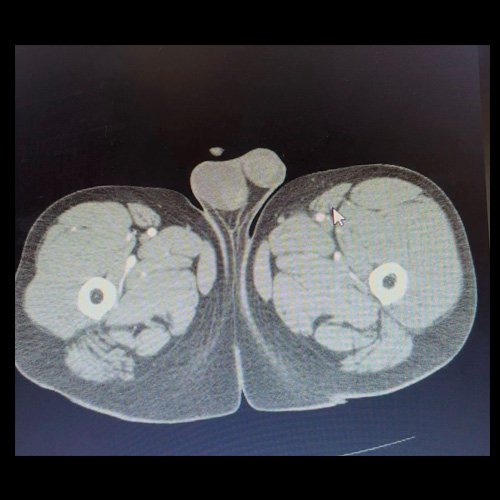 AngioTAC de miembros inferiores HEEP