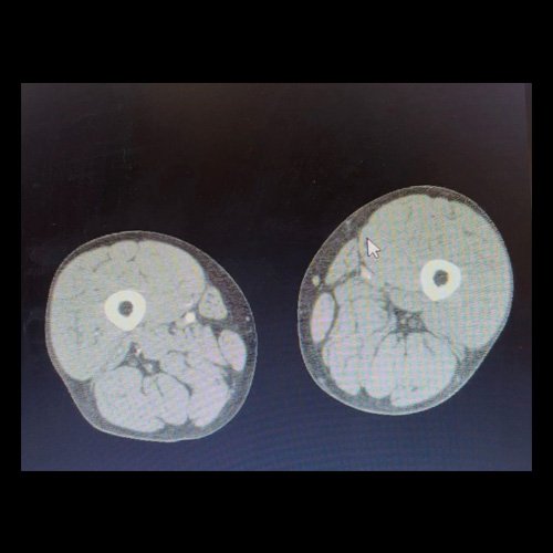 AngioTAC de miembros inferiores HEEP