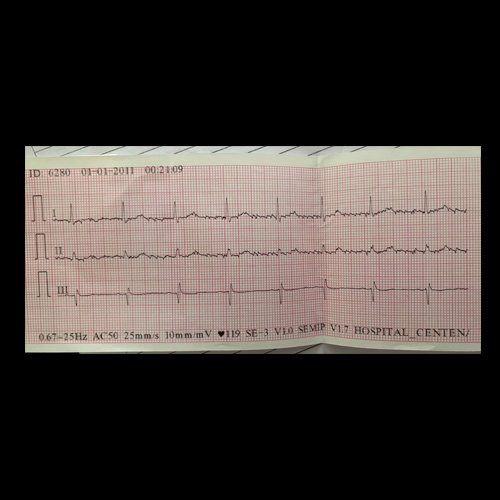 Electrocardiograma DÍA 0