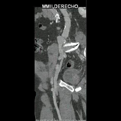 Flebotomografia de miembros inferiores (Día 18)