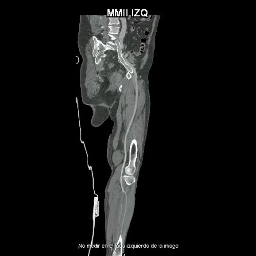 Flebotomografia de miembros inferiores (Día 18)