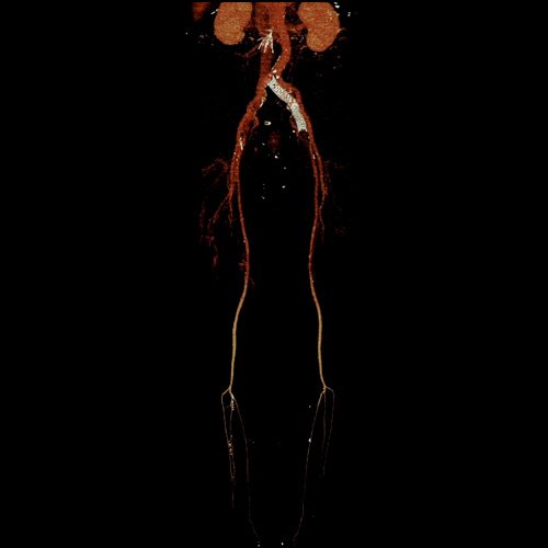 Flebotomografia de miembros inferiores (Día 18)