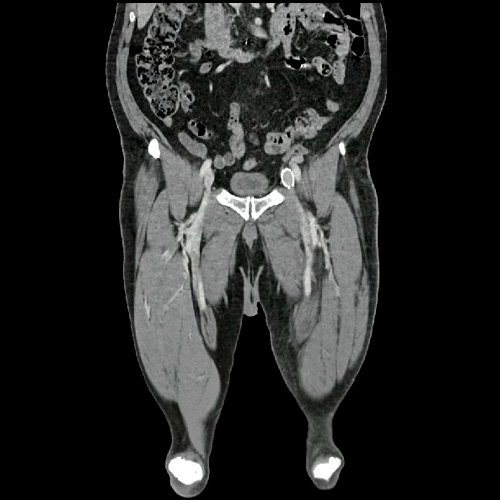 Flebotomografia de miembros inferiores (Día 18)