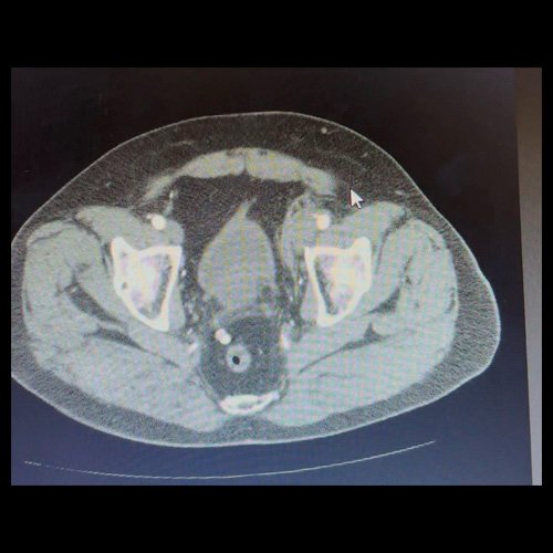 Isquemia crítica en miembro inferior: una urgencia vascular con interrogantes diagnósticos