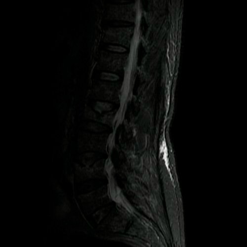Resonancia magnética (28/08/2026) STIR CORTE SAGITAL 