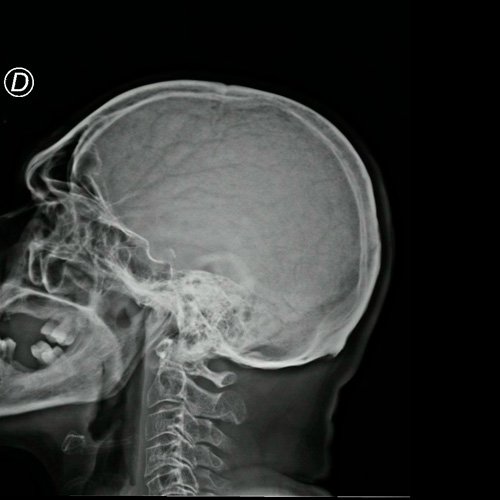 Radiografía de cráneo ( Día 11) Perfil 