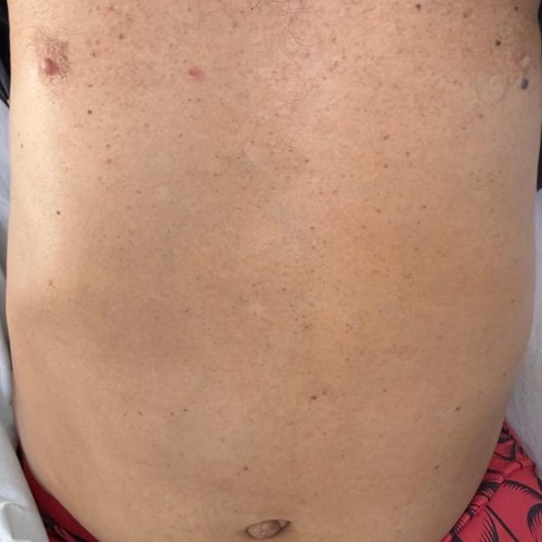 Ginecomastia y telangiectasias