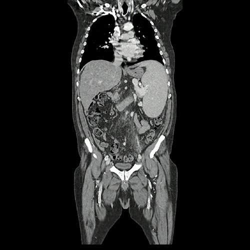 Tomografía de abdomen y pelvis con contraste. Corte coronal. VER CUAL