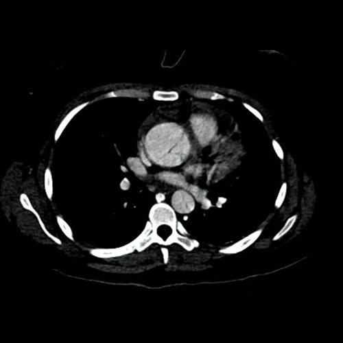 Angiotomografía con contraste endovenoso de aorta torácica. Corte axial. 