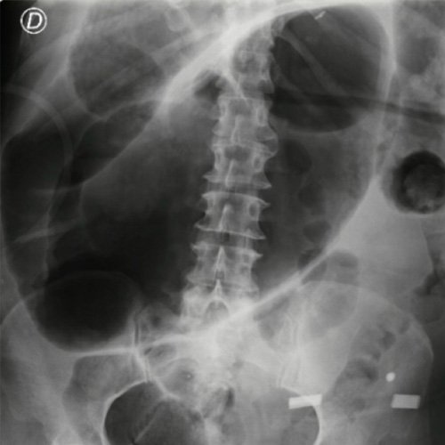 Polineuropatía de etiología incierta: ¿multicausal?