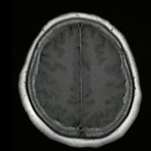 Disminución de la agudeza visual en mujer con cefalea y paquimeningitis crónica