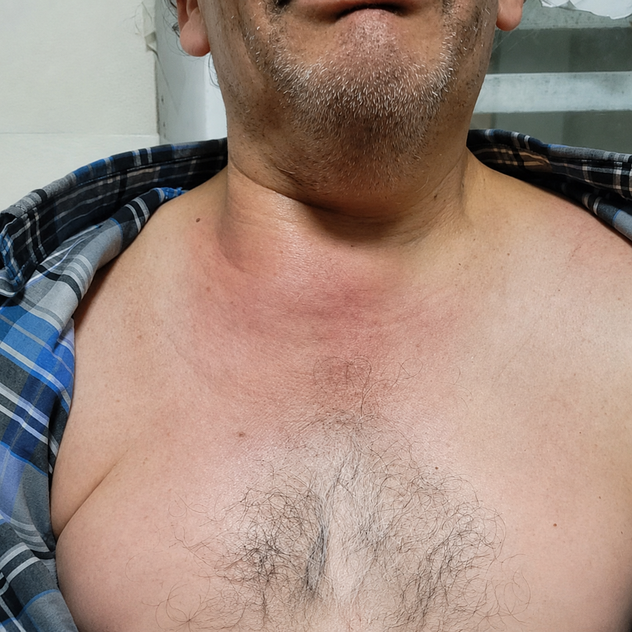 Más allá del foco pulmonar: un caso de infección invasiva en estudio.
