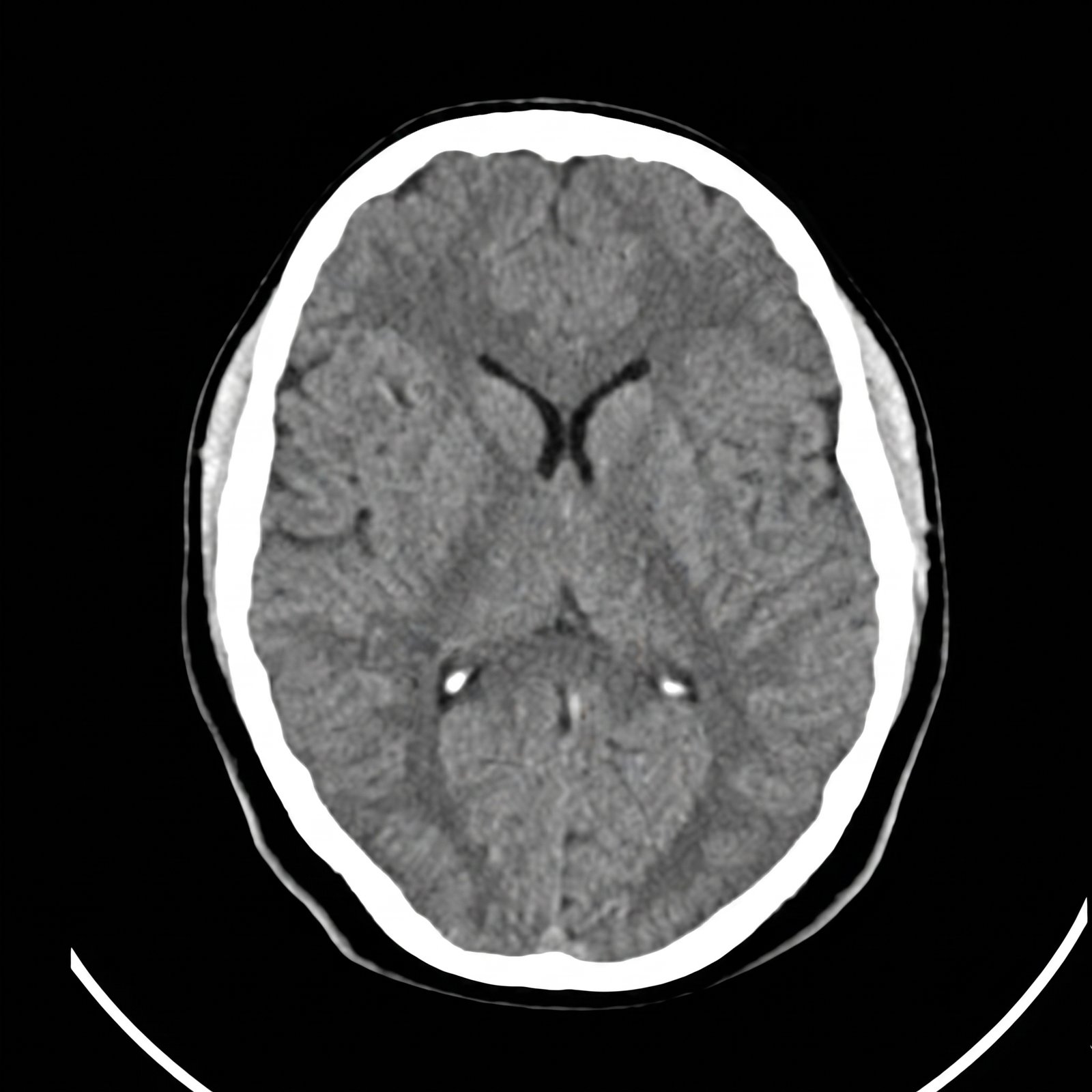 Ataque cerebrovascular en paciente joven