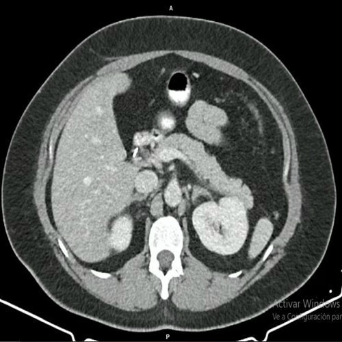 Mujer de 39 años con hiponatremia