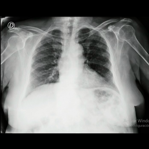 Mujer de 70 años con isquemia digital, fiebre prolongada y lesiones ocupantes de espacio en glándulas suprarrenales